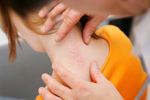 Sedef hastalığı için Türkiye’de yaklaşık 9 aydır kullanımı olan sekukinumab