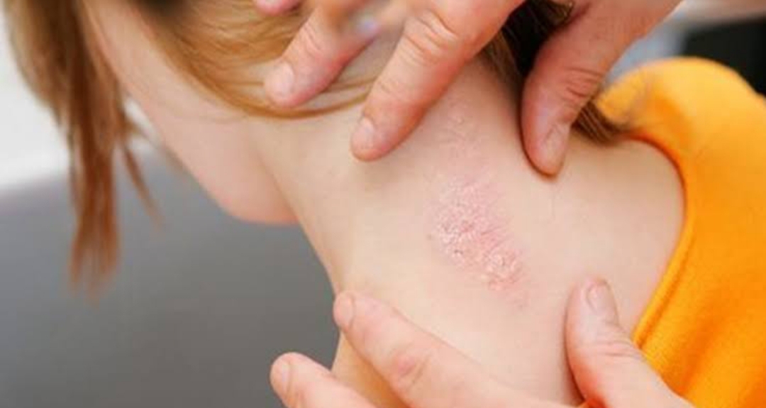 Abdi İbrahim Medikal Direktörlüğü, 29 Ekim Dünya Sedef Günü dolayısıyla,