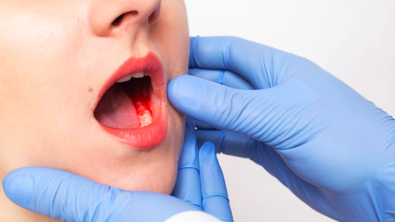 Takma Diş Takanlar Dikkat