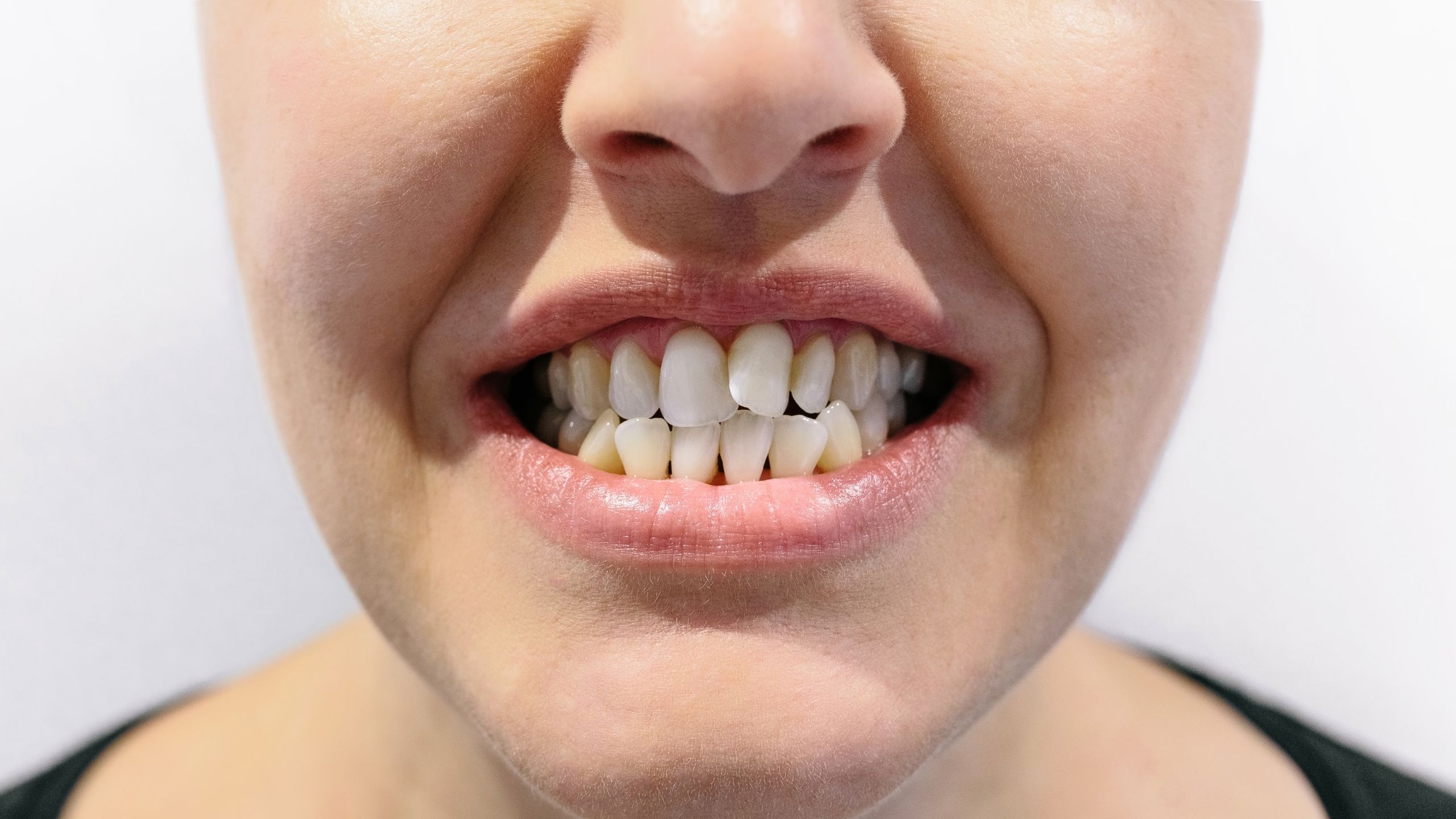 Çarpık Diş Tedavisi İçin Şeffaf Plak Tedavisi