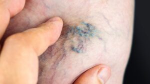 Bir damarın çapının olması gerekenden iki misli genişlemesine anevrizma denir.