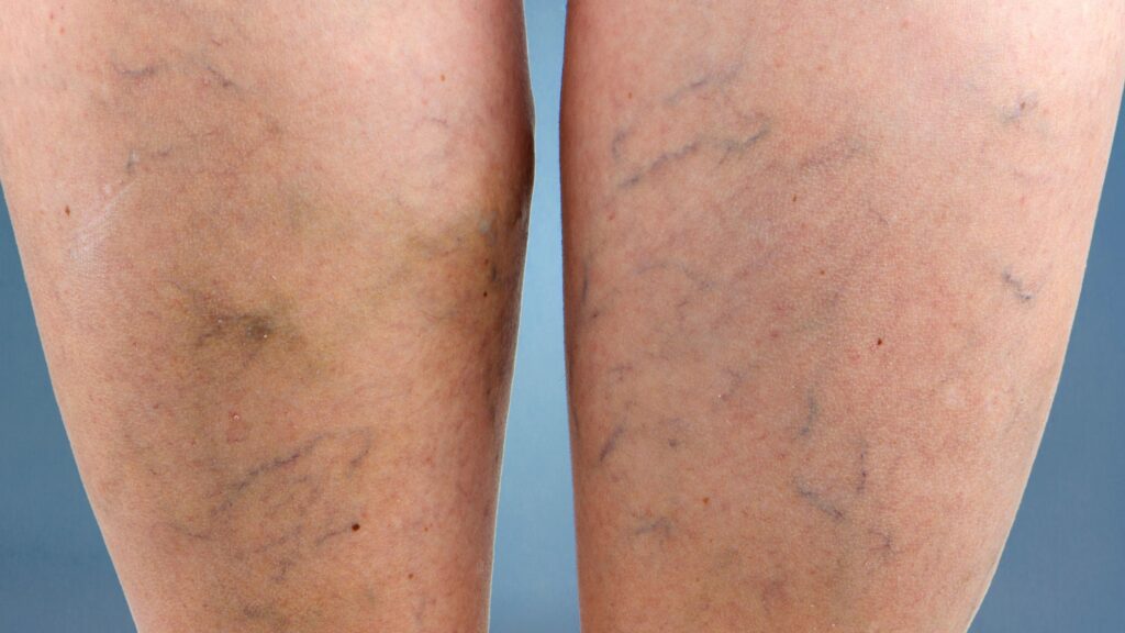 Damar, Çapının İki Katı Genişlerse Ne Olur?