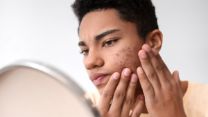 Halk arasında köpek memesi adıyla bilinen hidradenitis suppurativa (HS) hastalığına