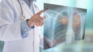 Akciğer kanserinin tedavisinde ilk aşamayı genellikle cerrahi operasyonlar oluşturuyor. Teknolojik