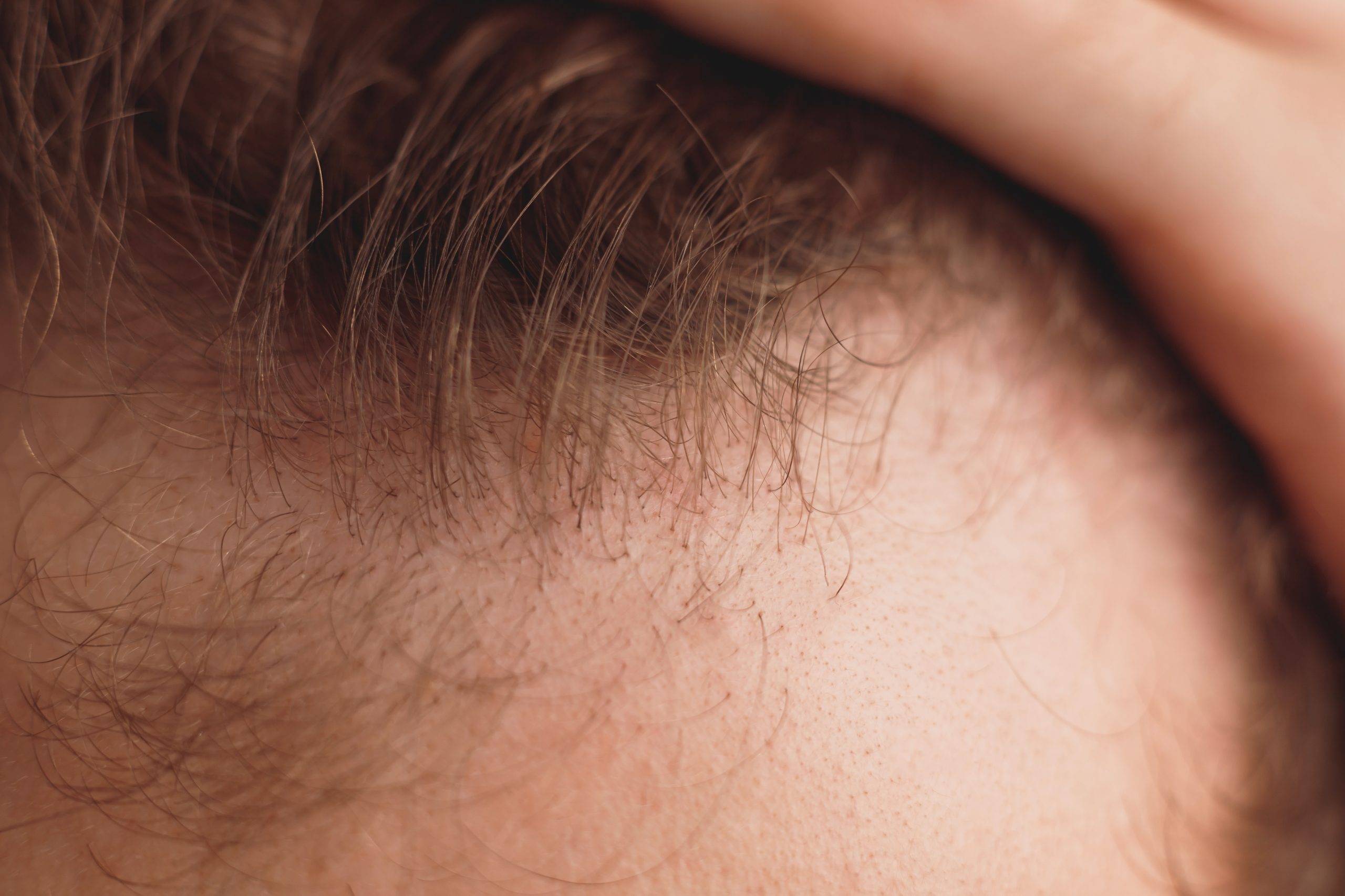 balding-man-is-opening-his-forehead-close-up-view-2022-12-16-21-40-39-utc-scaled.jpeg