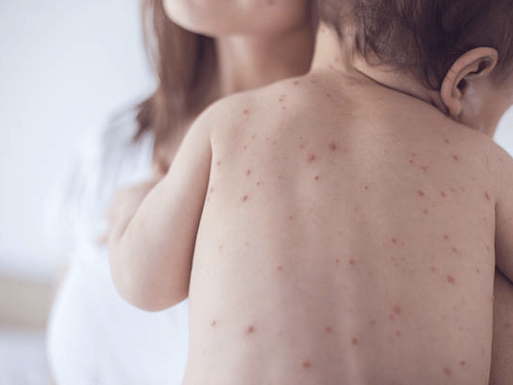 “Alerjik Çocuklara Kızamık Aşısı Önlemler Alınarak Yapılabilir”